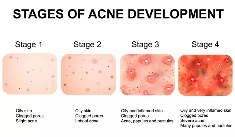 Cystic_acne